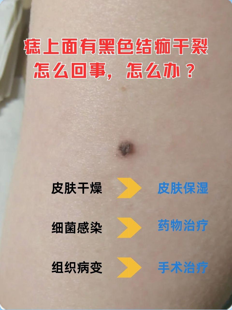 痣上黑色结痂干裂暗藏风险 痣,这一常见的皮肤特征,有时却可能成为