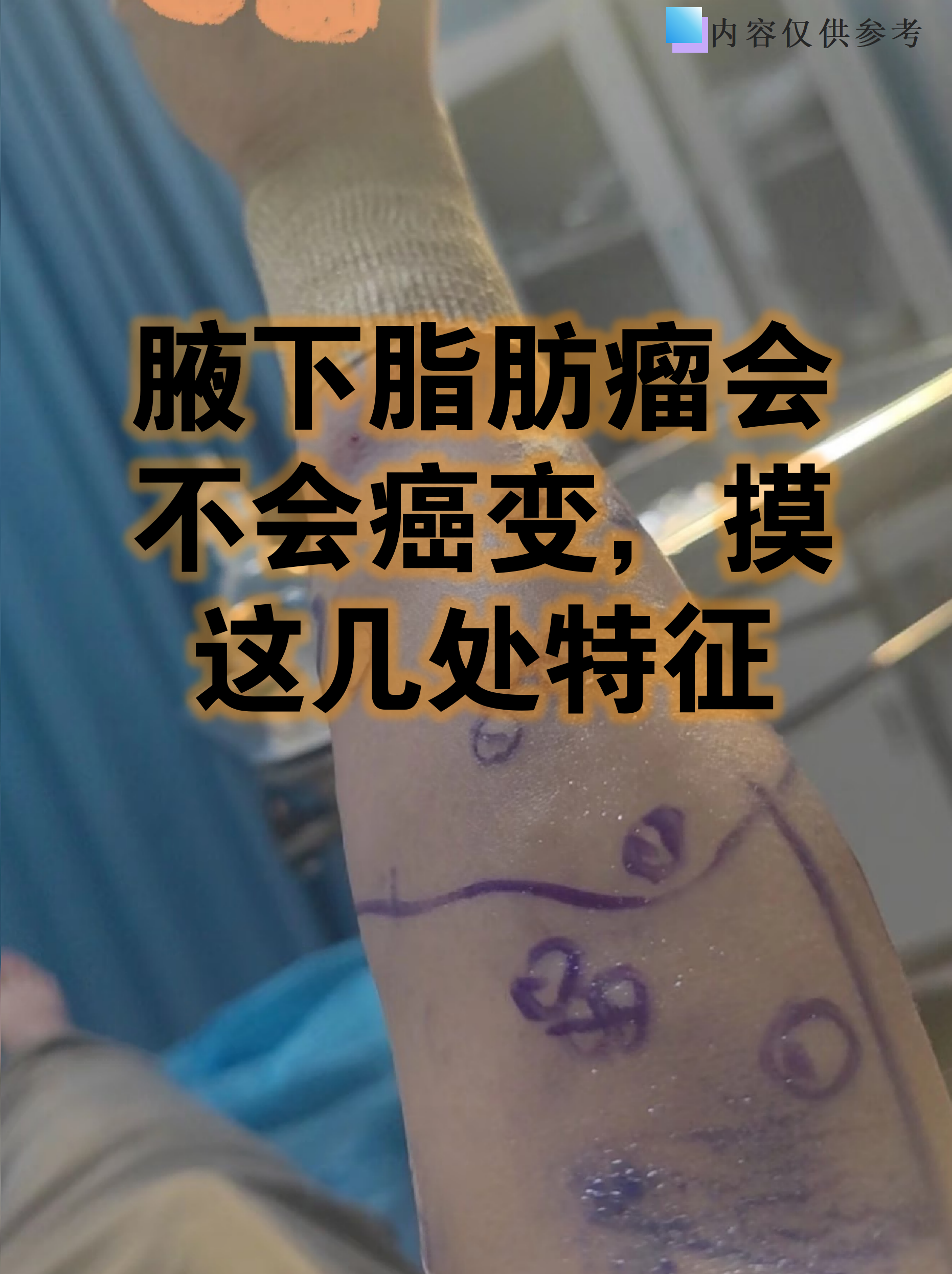 其实脂肪瘤癌变概率极低,但学会自查特征能帮你更安心