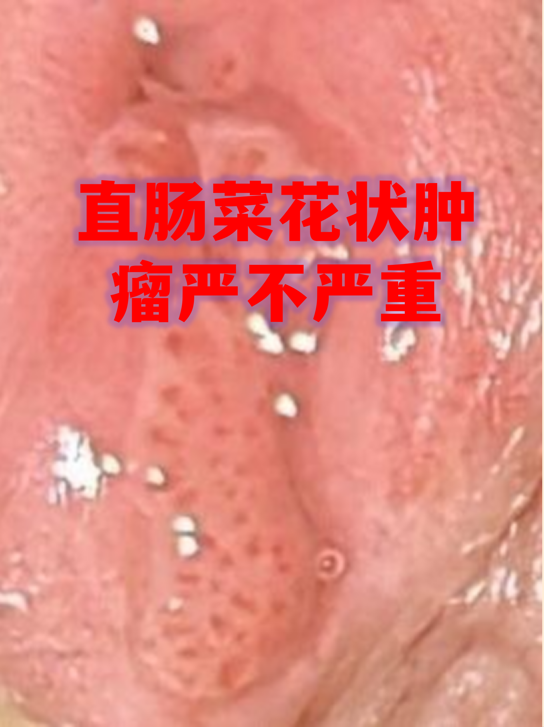 直肠菜花状肿物常见特征 形态特点:表面呈