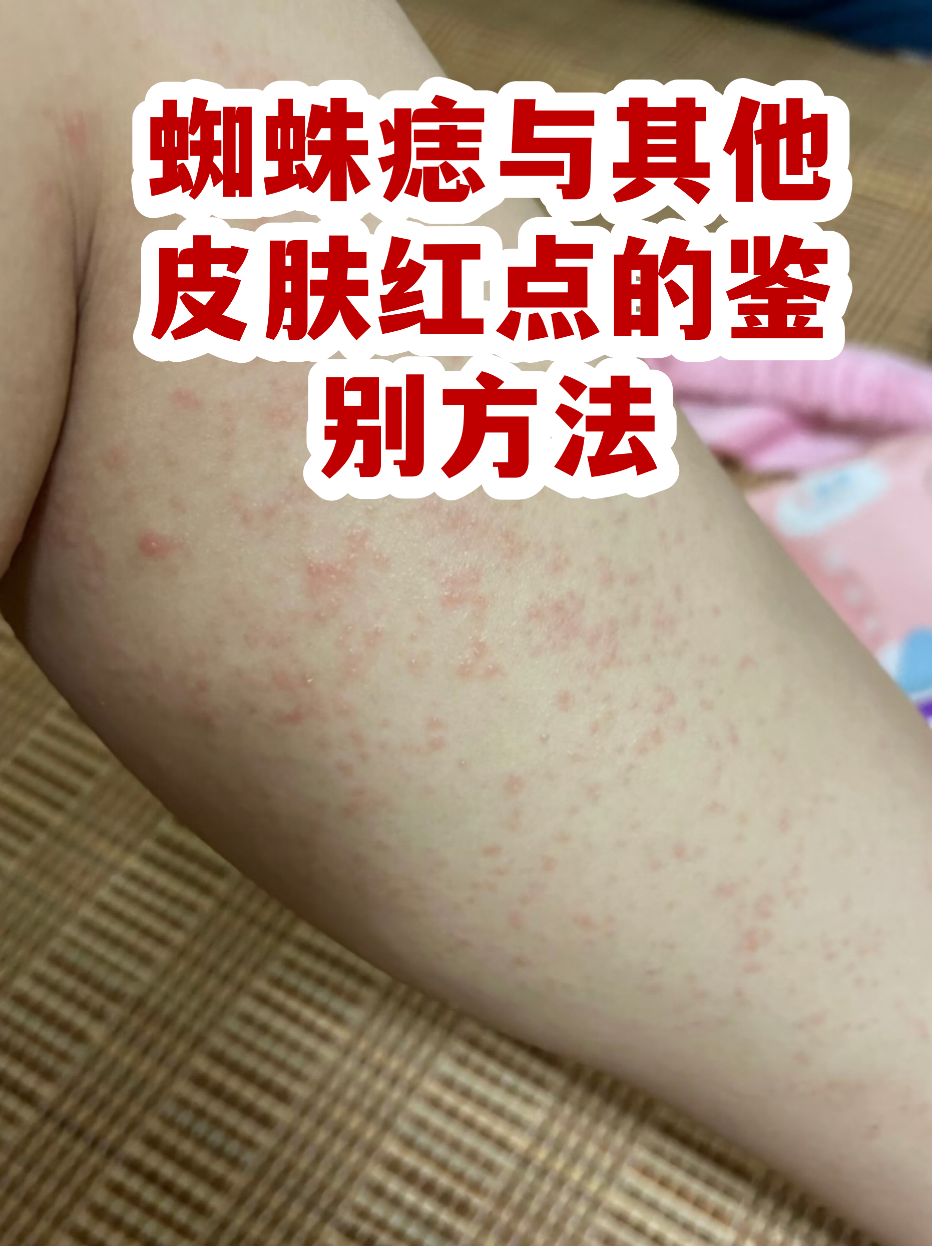 蜘蛛痣与其他皮肤红点的鉴别方法