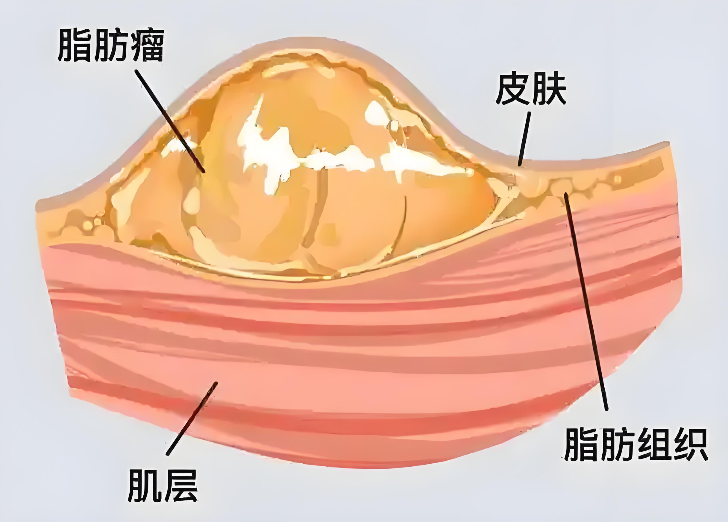 脂肪瘤消除方法大揭秘 脂肪瘤的消除方法多样,主要包括手术切除,吸脂