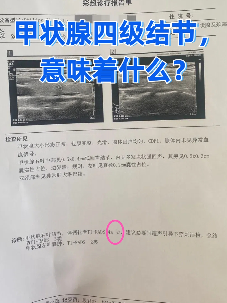 甲状腺结节根据其在超声下的表现,可以分为不同的等级,其中四级是一
