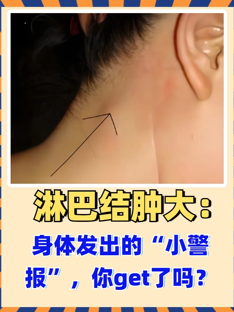 肿大淋巴结通常指淋巴结肿大