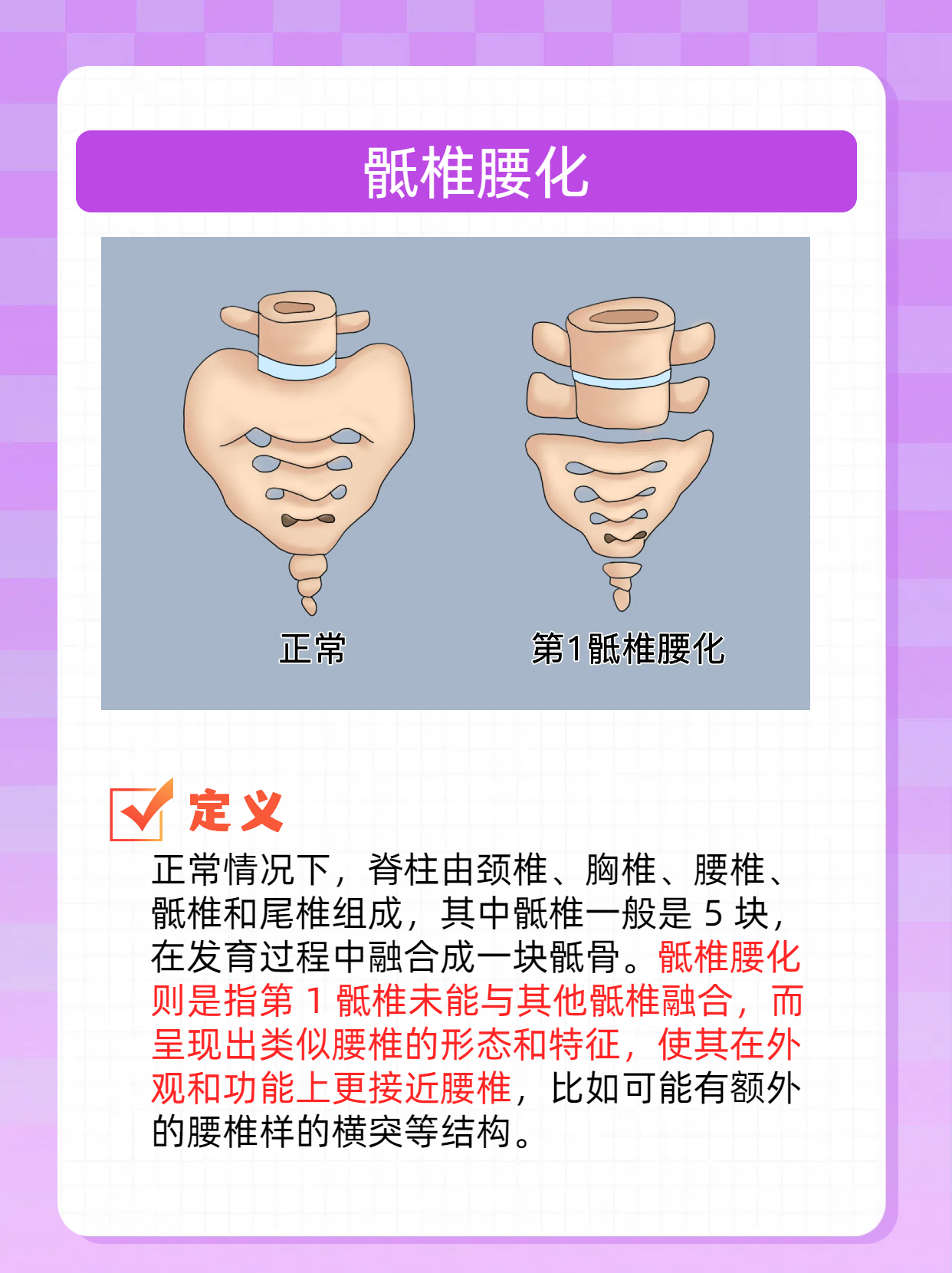 骶椎腰化:脊柱的"特别编排" 骶椎腰化,简而言之,是指发育过程中第1