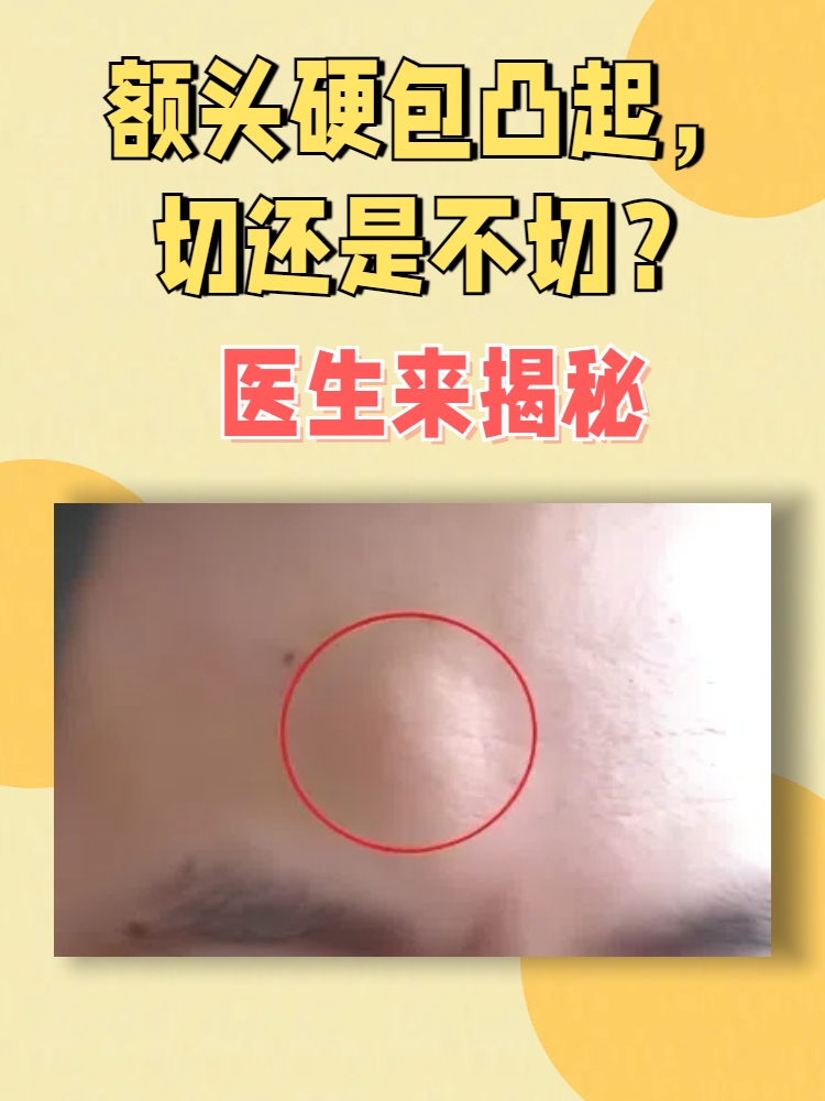 医生来揭秘 额头上长了个硬包凸起,这本身并不是一个罕见的状况