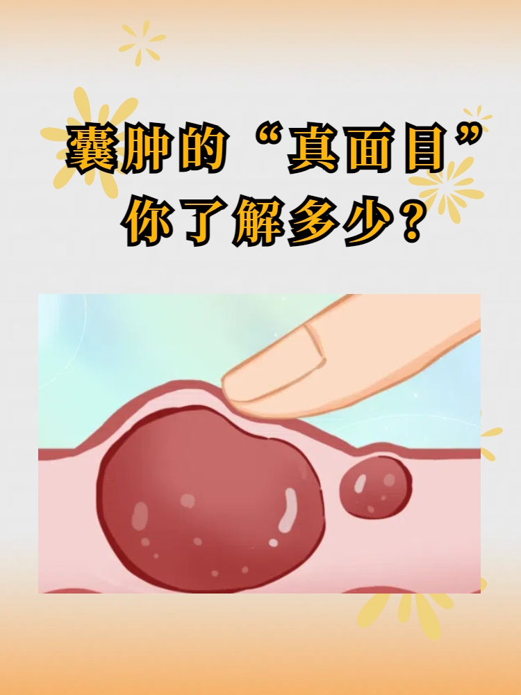 严重不?键销囊肿囊肿是什么原因引起的私下外面长囊肿图片
