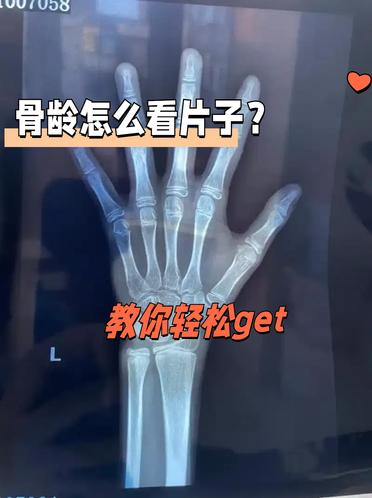 教你轻松get 要看懂骨龄片子,其实并不复杂!