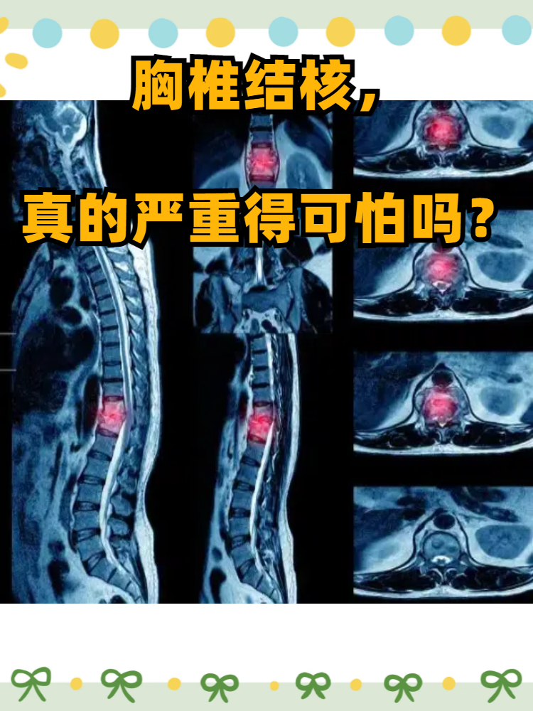 胸椎结核如果得不到及时治疗,可能会引发严重后果,影响脊柱稳定性和