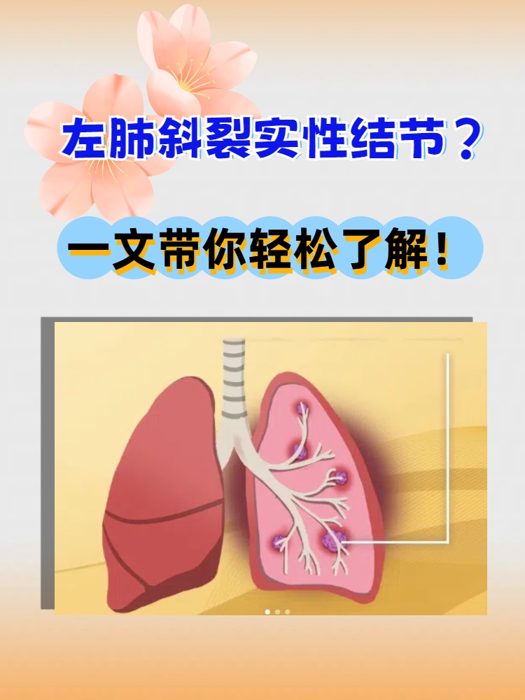 左肺斜裂是左肺上叶和下叶之间的自然解剖分隔,而实性结节是指在影像