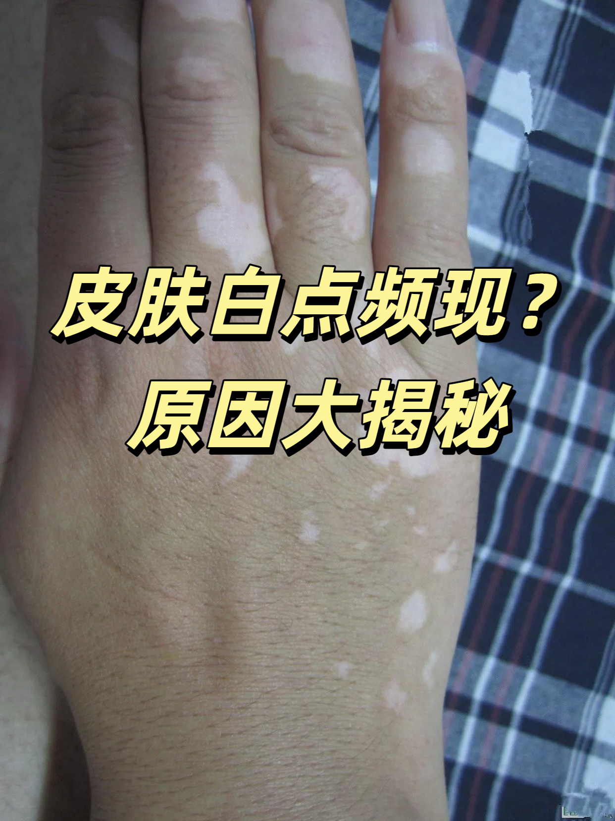 1,白癜风 这是一种较为常见的色素脱失性皮肤病