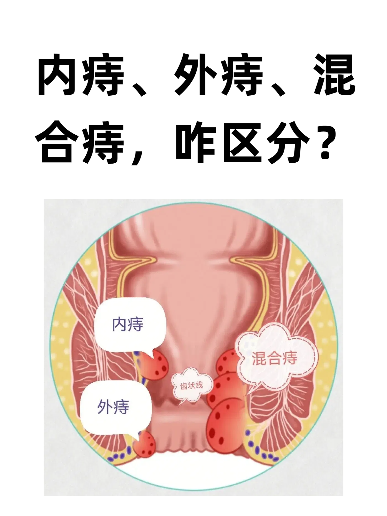 痔疮的三种常见类型,主要区别在于发生位置和临床表现:内痔长在肛门齿