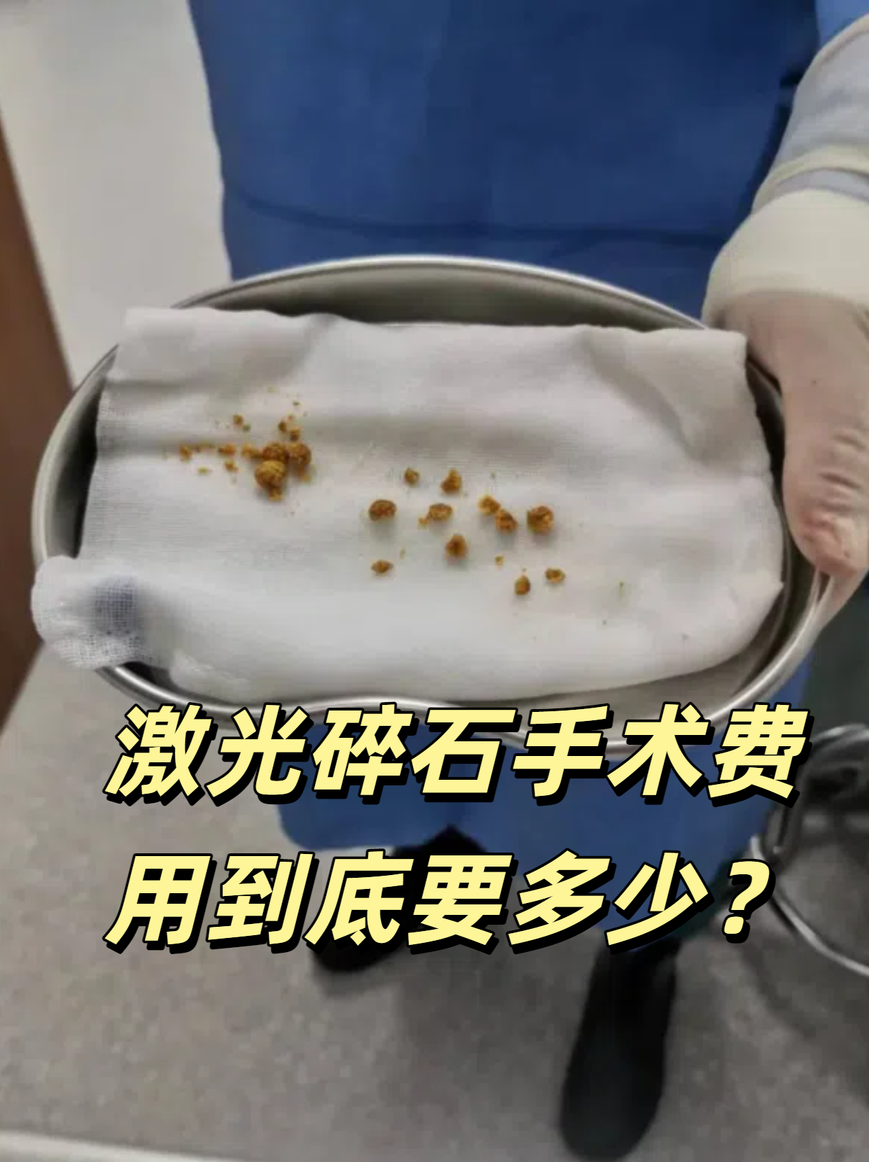 激光碎石手术费用到底要多少?