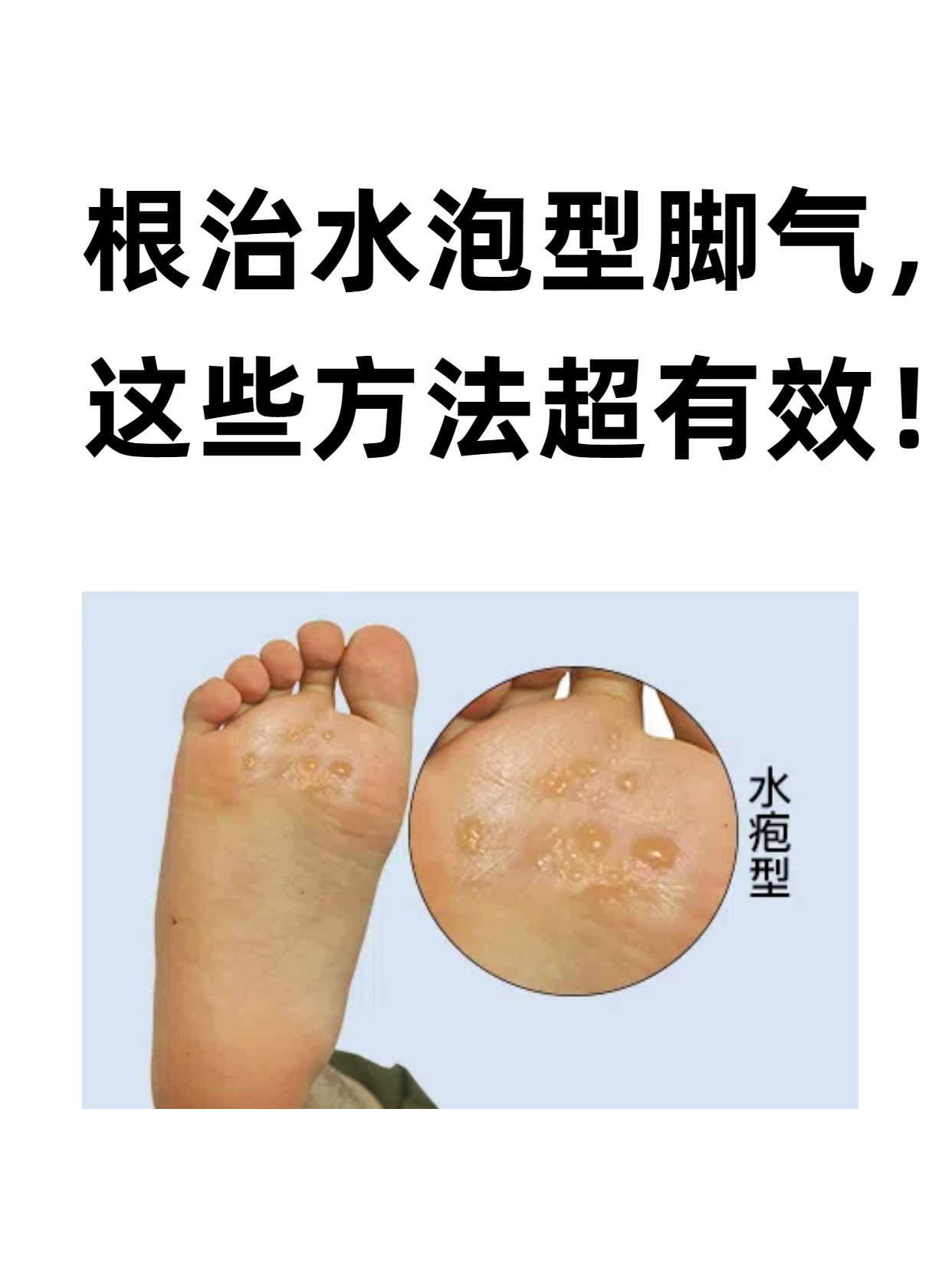 水泡型脚气,医学上称为水疱型足癣,是由真菌感染引起的常见皮肤病