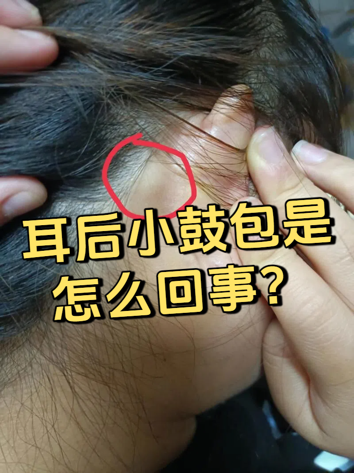 耳后出现小鼓包,常见原因包括淋巴结肿大,皮脂腺囊肿或毛囊炎,少数