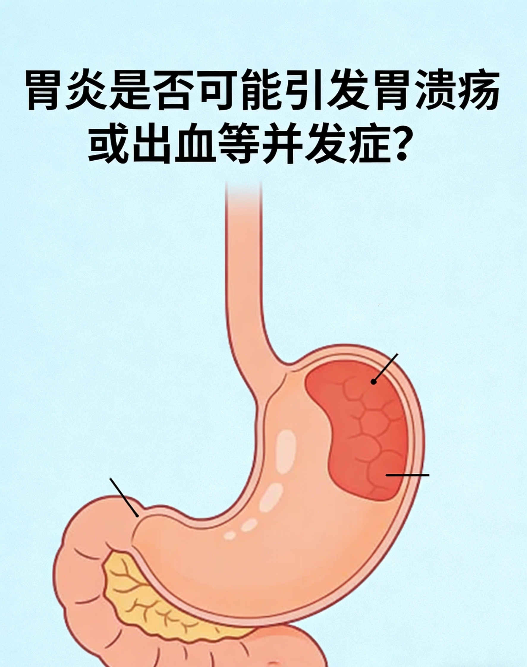 慢性胃炎若持续进展局部黏膜糜烂可发展为胃溃疡尤其当合并幽门螺