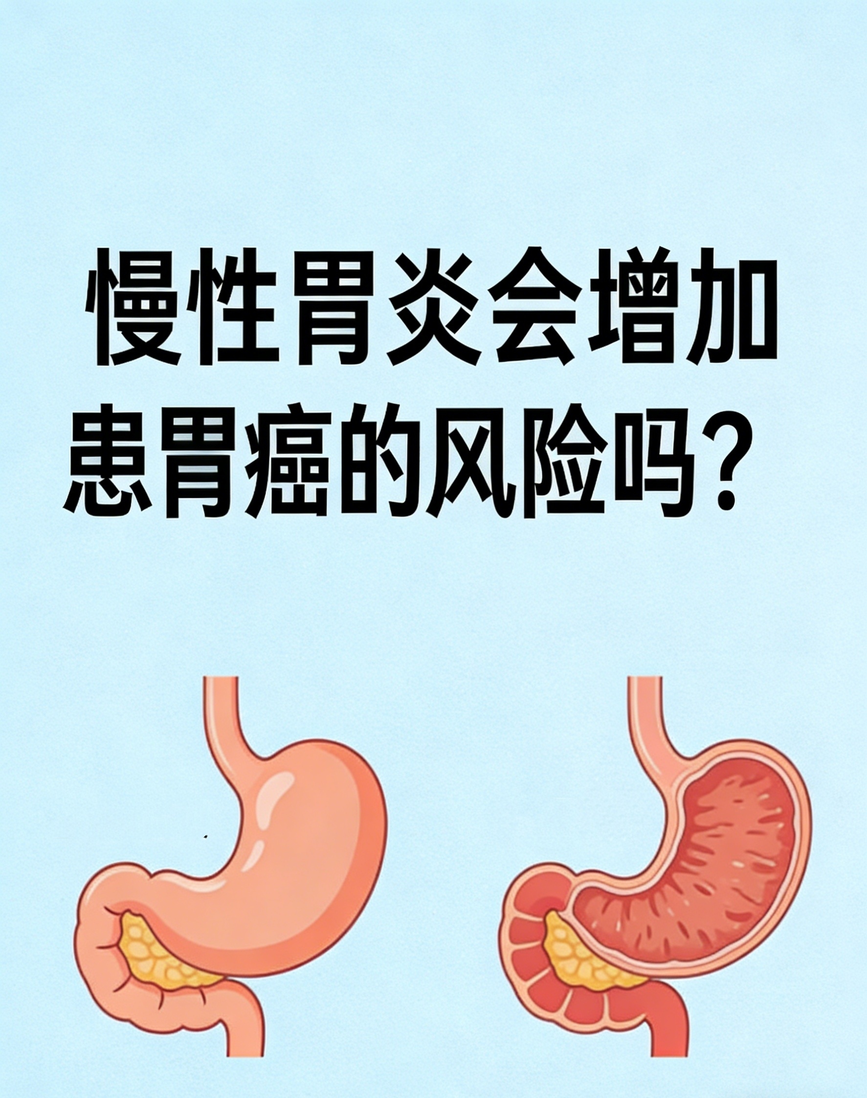 部分类型的慢性胃炎确实会增加胃癌风险尤其是伴随幽门螺杆菌感鹊哪