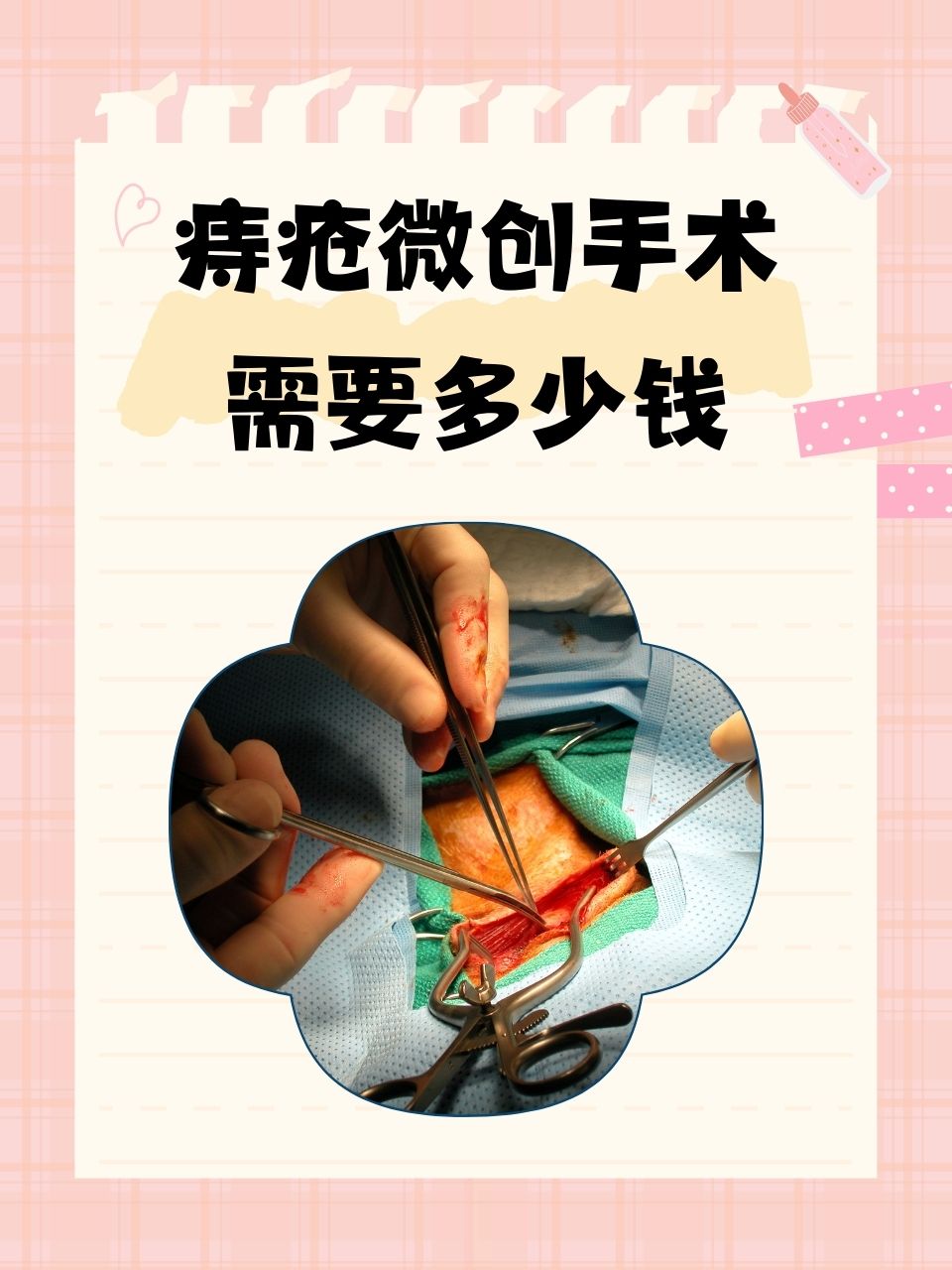 痔疮微创手术