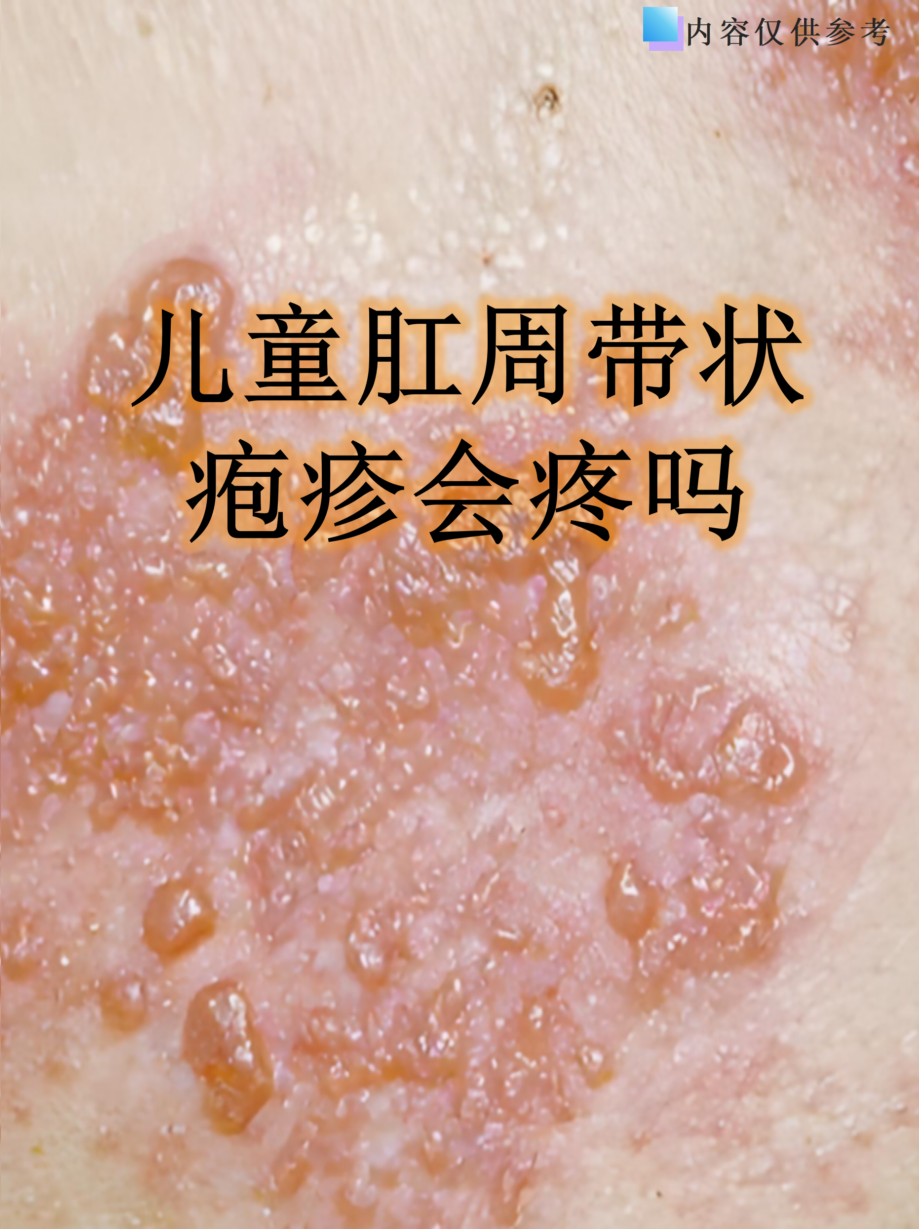 儿童肛周带状疱疹会疼吗