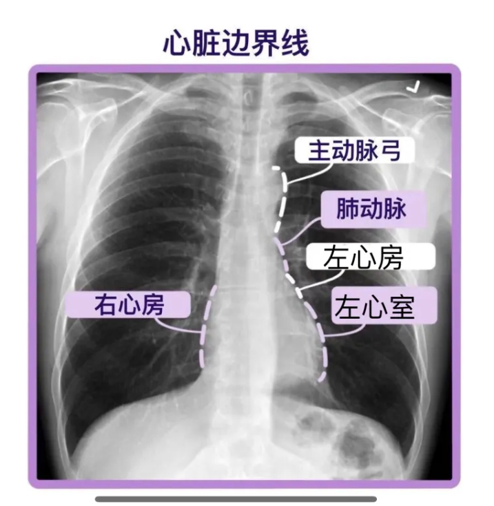 从胸片上来识别心脏的边界,看看心脏长什么样子?