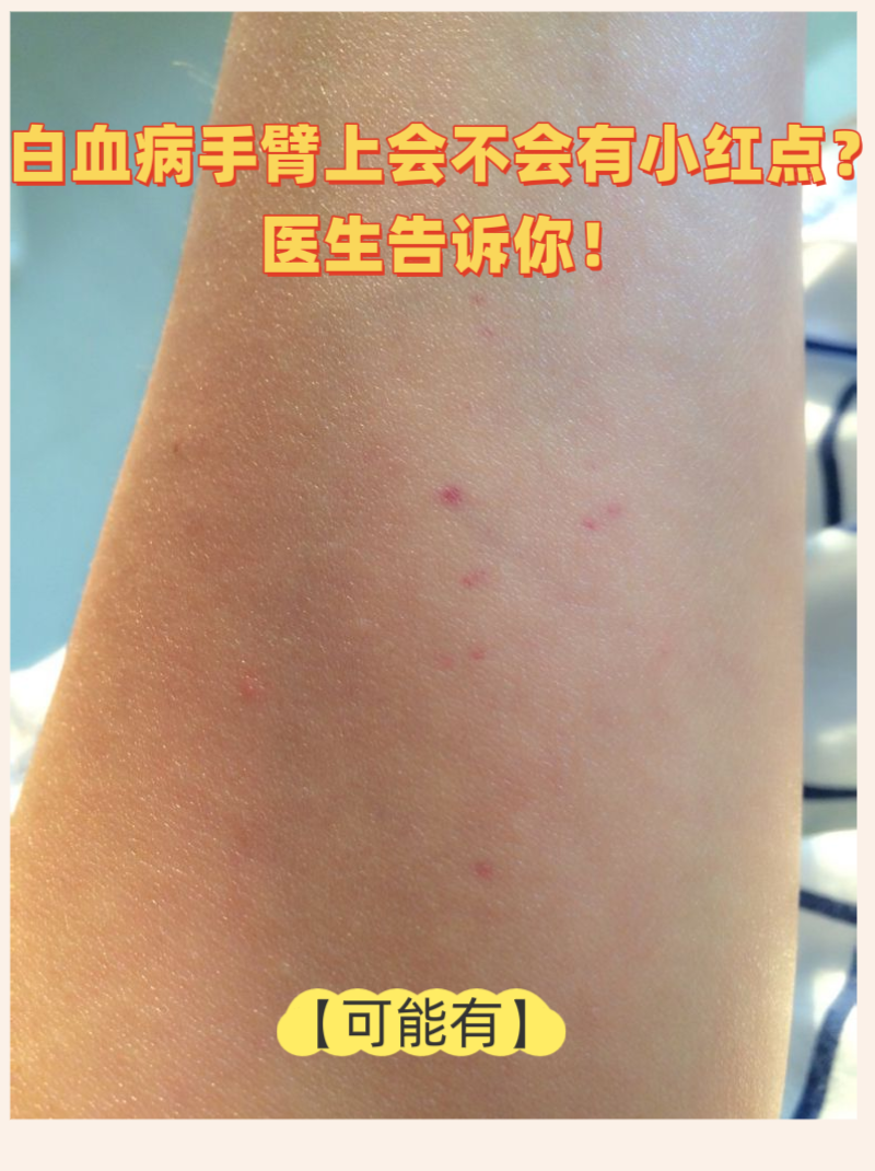 白血病手臂上会不会有小红点?医生告诉你!