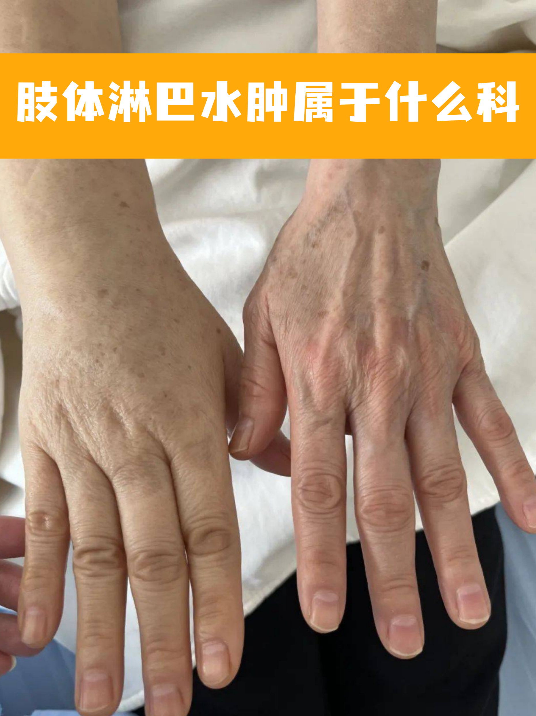 肢体淋巴水肿属于什么科