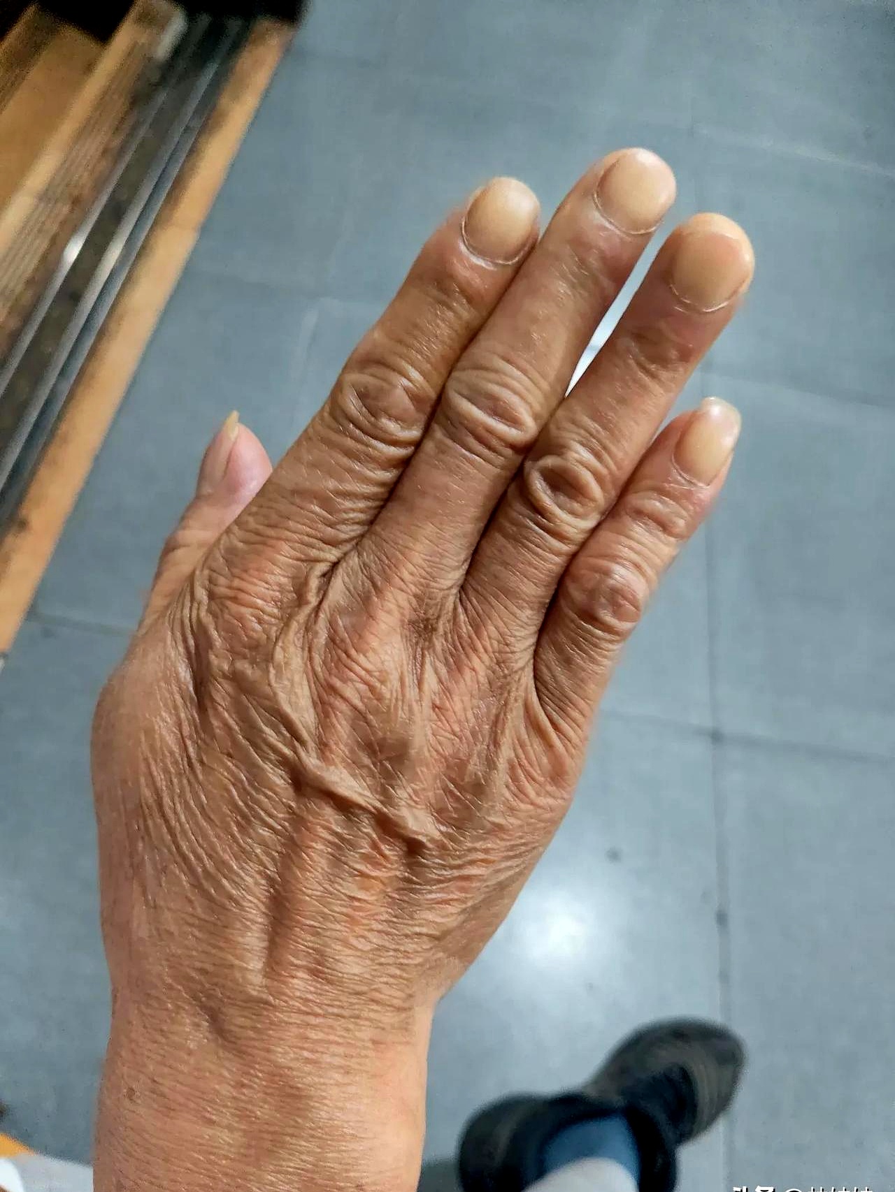 我的公公,今年69岁的一个老人,不知道什么原因,去年开始双手不管做