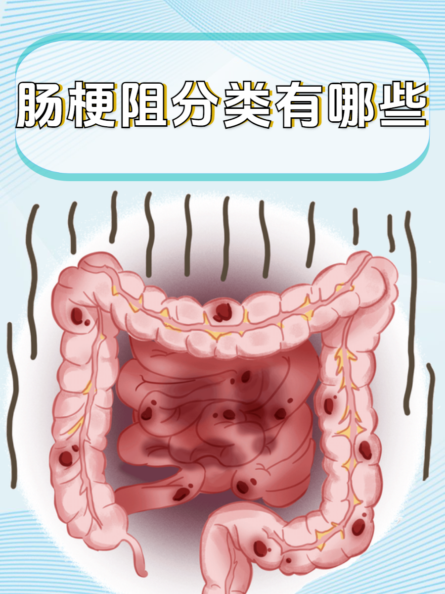 肠梗阻思维导图图片