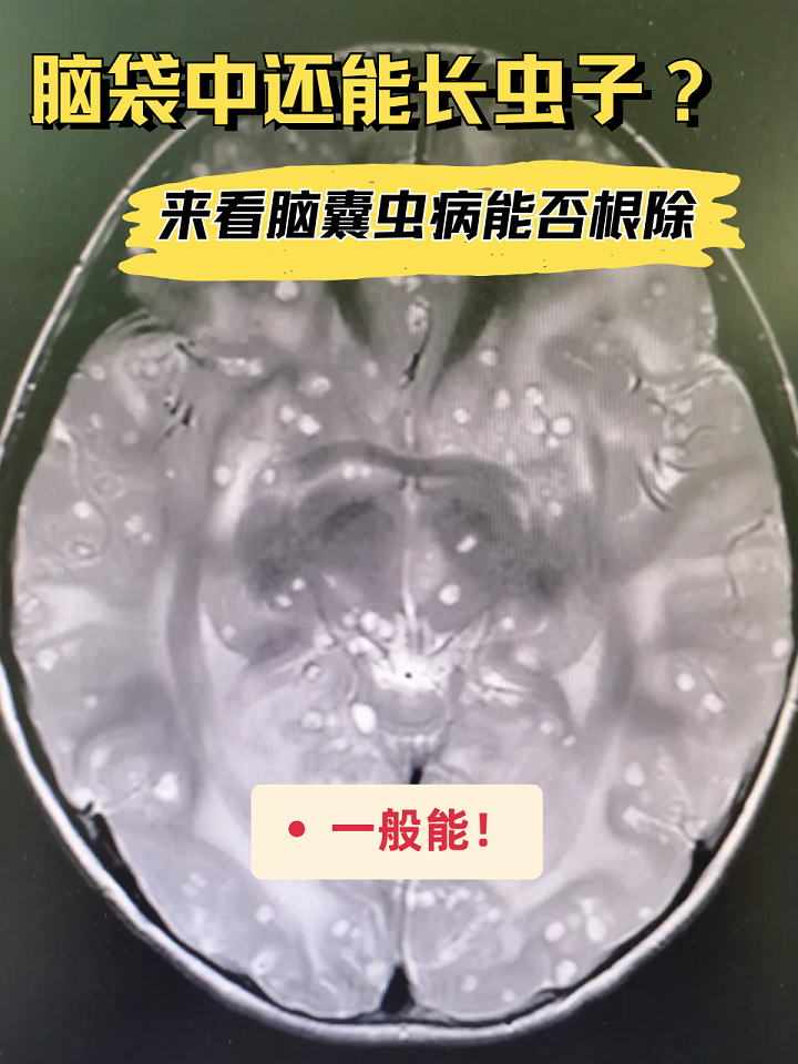 来看脑囊虫病能否根除