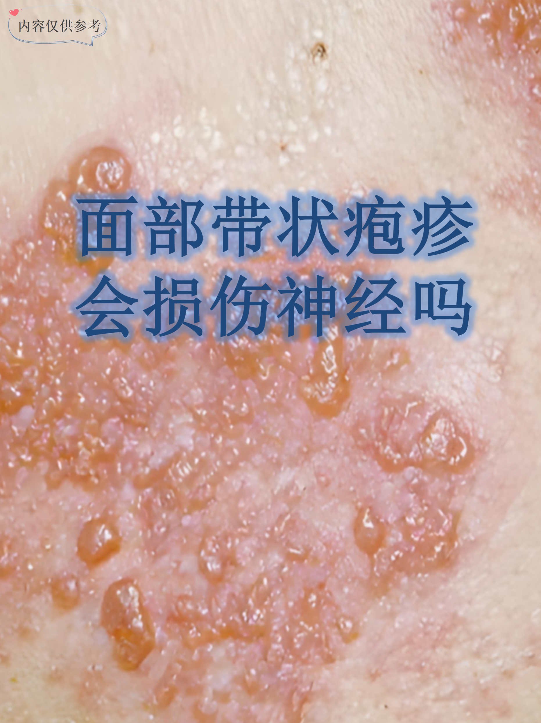 面部带状疱疹会损伤神经吗