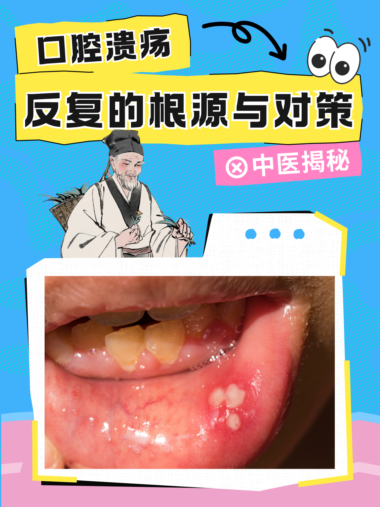 为什么会口腔溃疡发病原因为什么在线