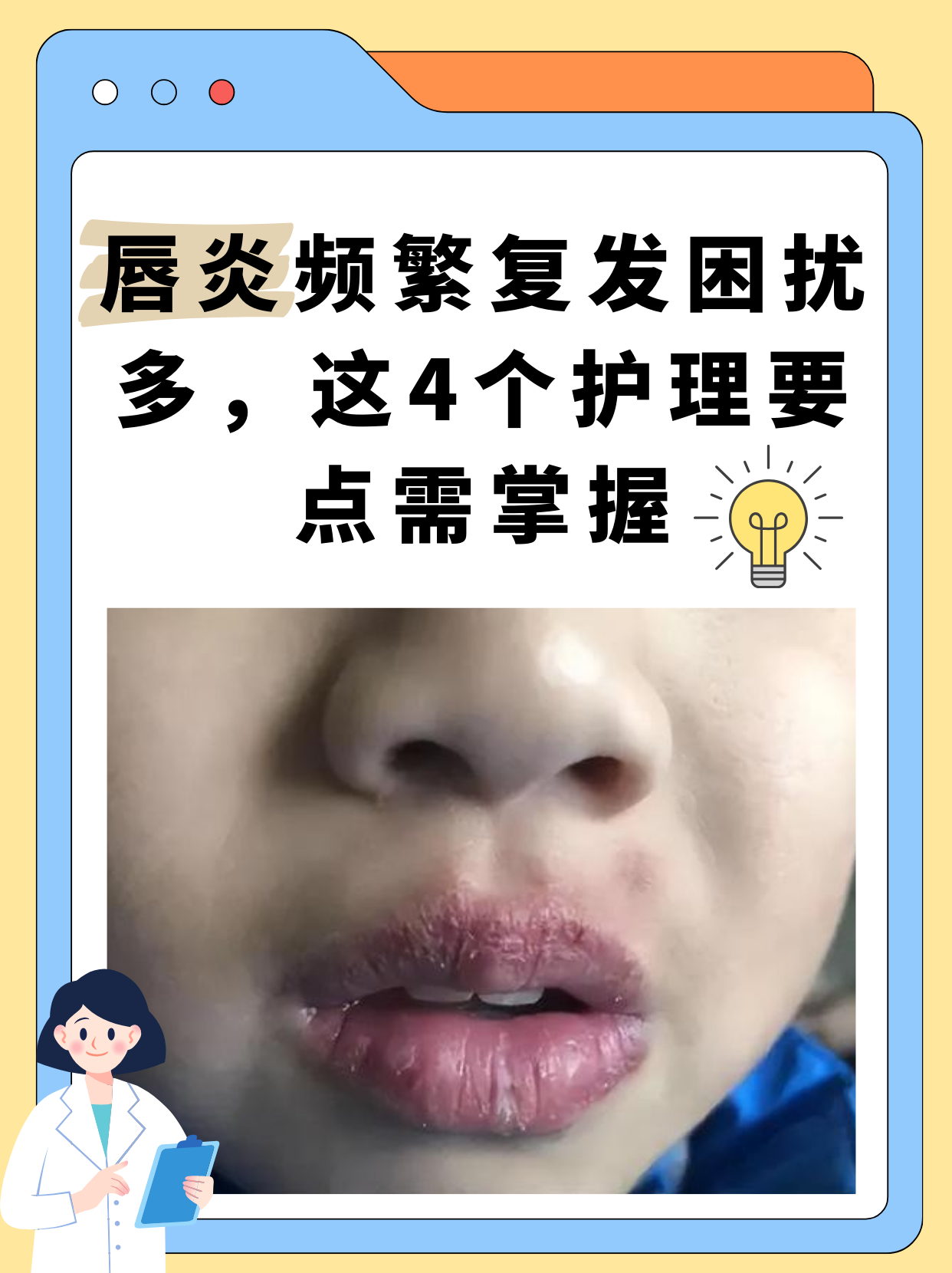 唇炎频繁复发困扰多,这4护理要点需掌握