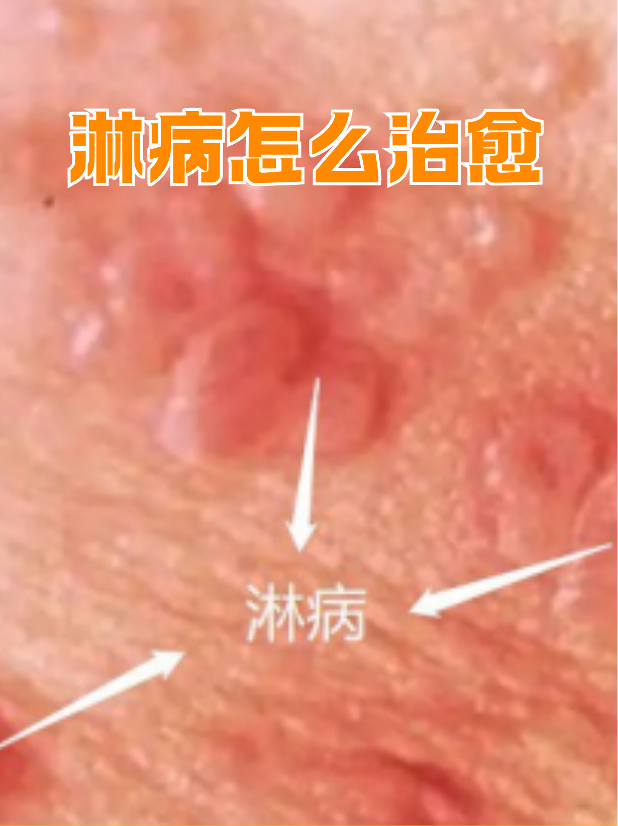 淋病是由淋病奈瑟菌感染引起的性传播疾病,通过规范的