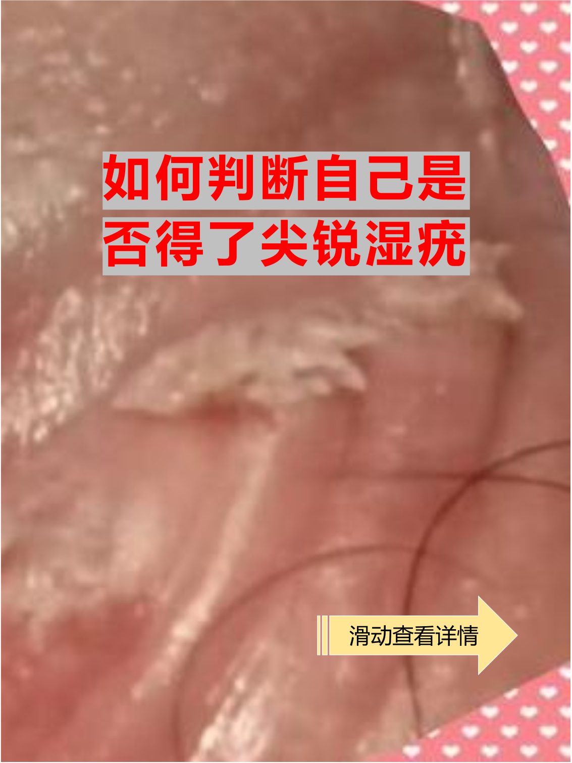 尖锐湿疣的典型症状 疣体