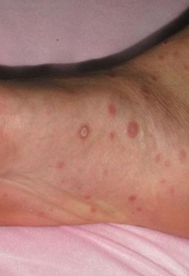 识别一期梅毒硬下疳的特征与演变过程