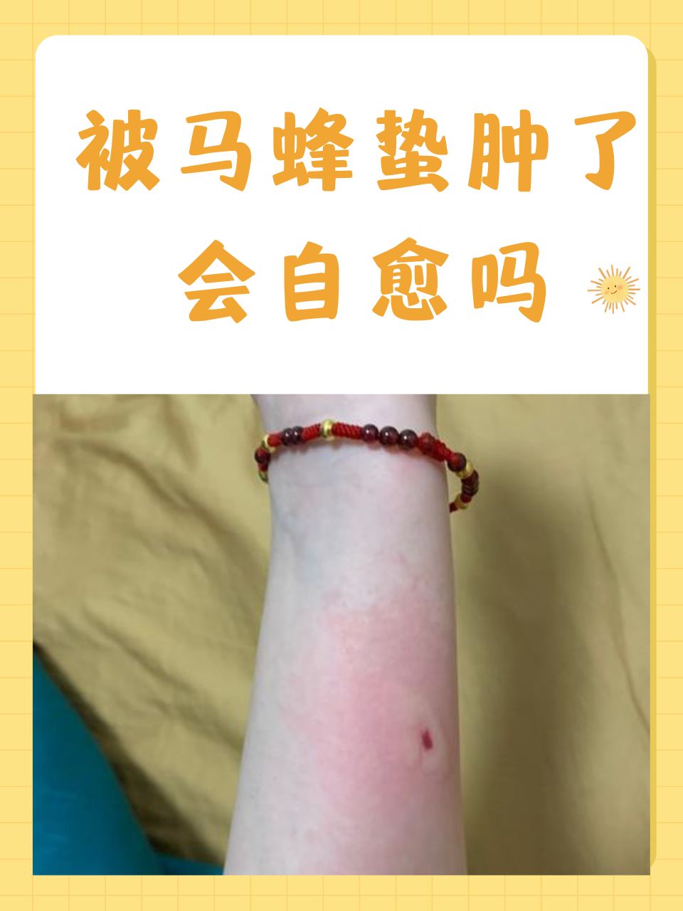 梦见被蜂蜜蛰是什么(梦见被蜂蜜咬)