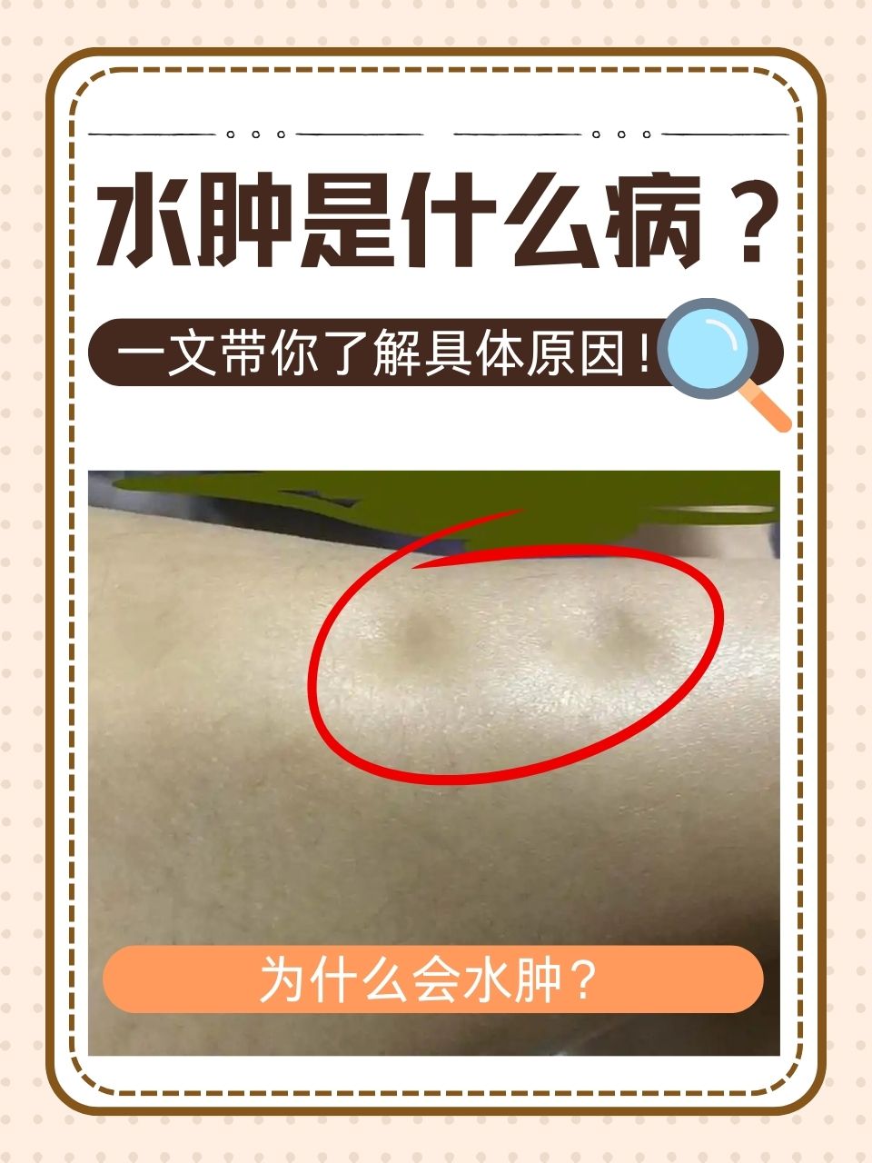 水肿并非单一疾病,而是一种临床症状,指组织间隙内的体液增多