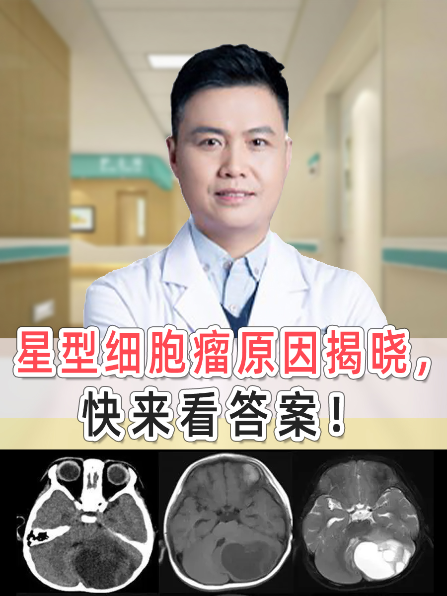 星形细胞瘤是指以星形胶质细胞所形成的肿瘤,男性多于女性