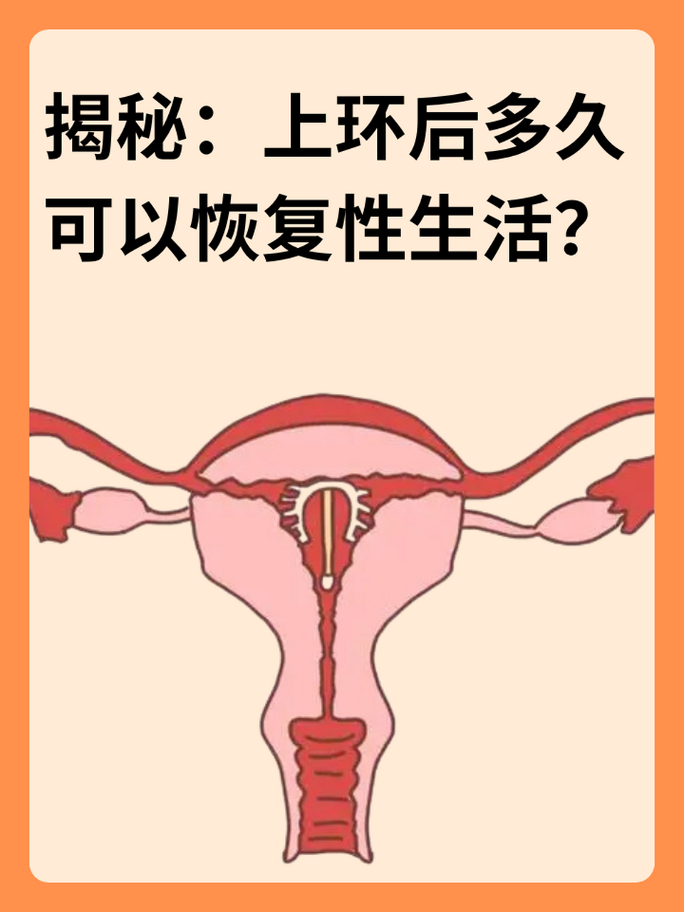 97揭秘:上环后多久可以恢复性生活?