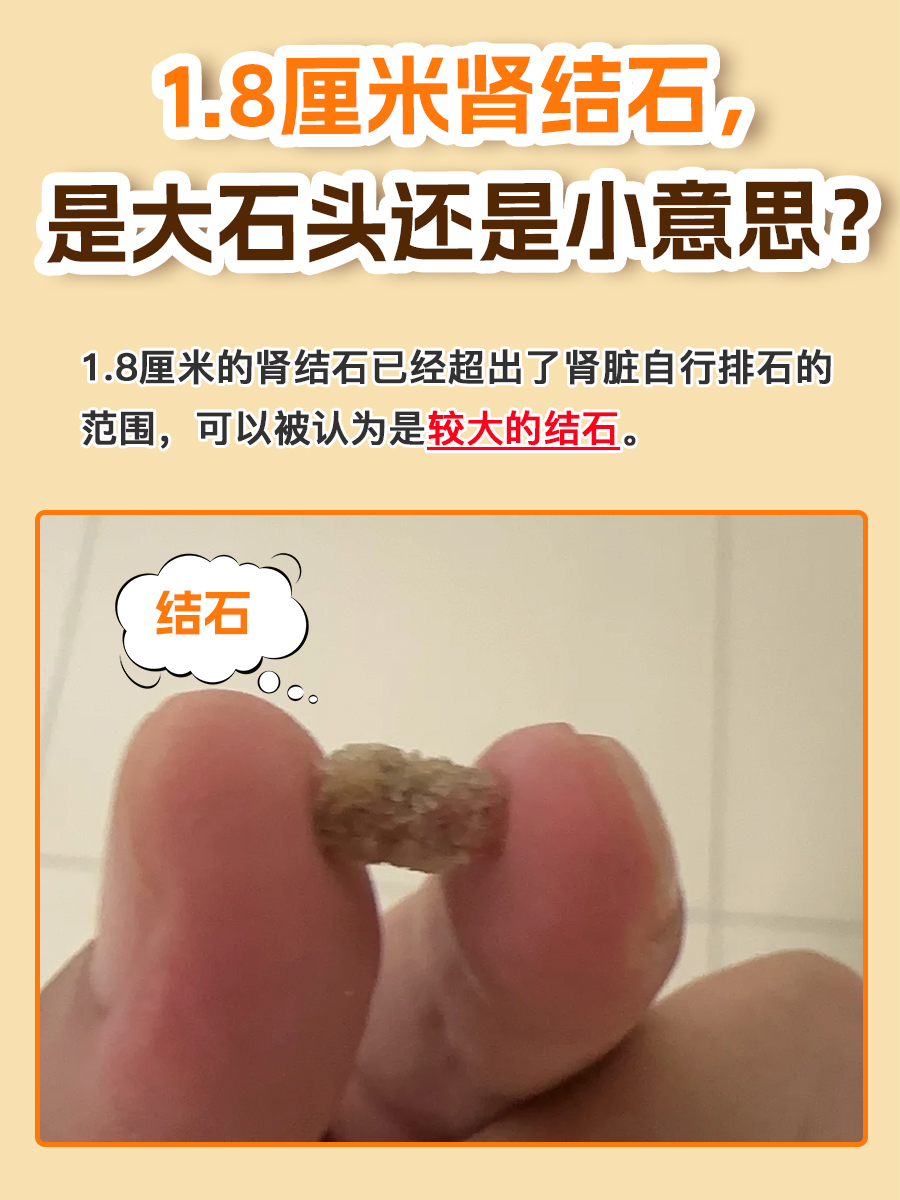 8厘米肾结石,是大石头还是小意思?