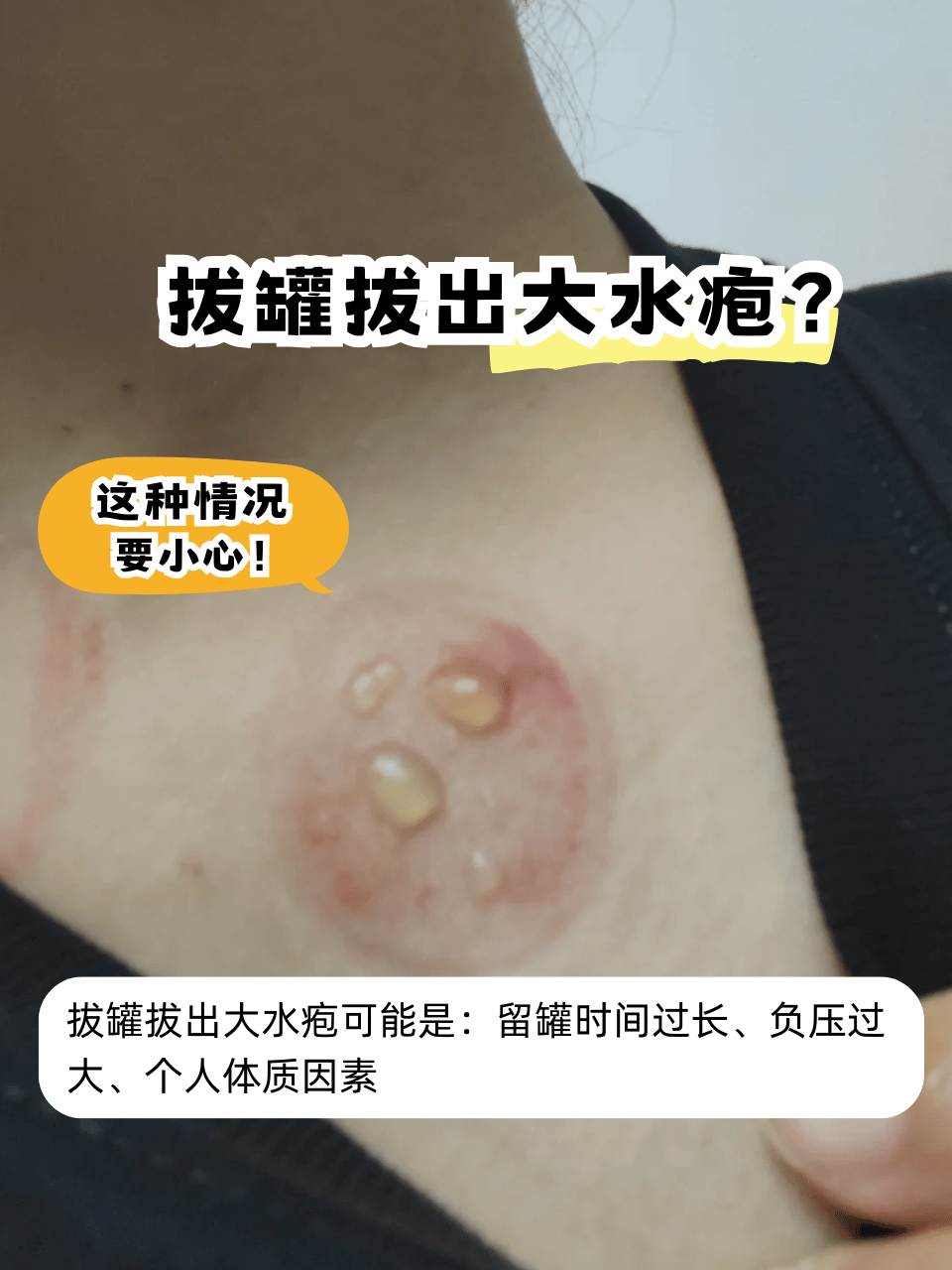 拔罐出水疱的常见原拔罐血泡火罐起泡是怎么回事