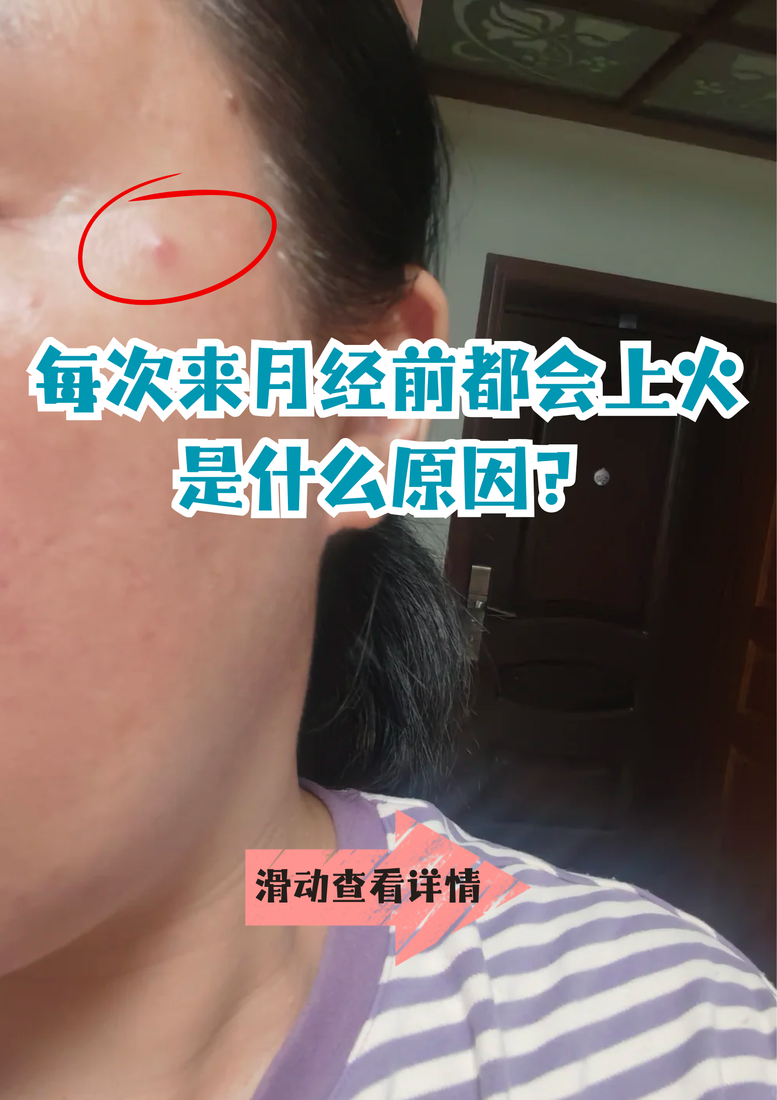 来姨妈长痘痘是为什么 来姨妈长痘痘是为什么