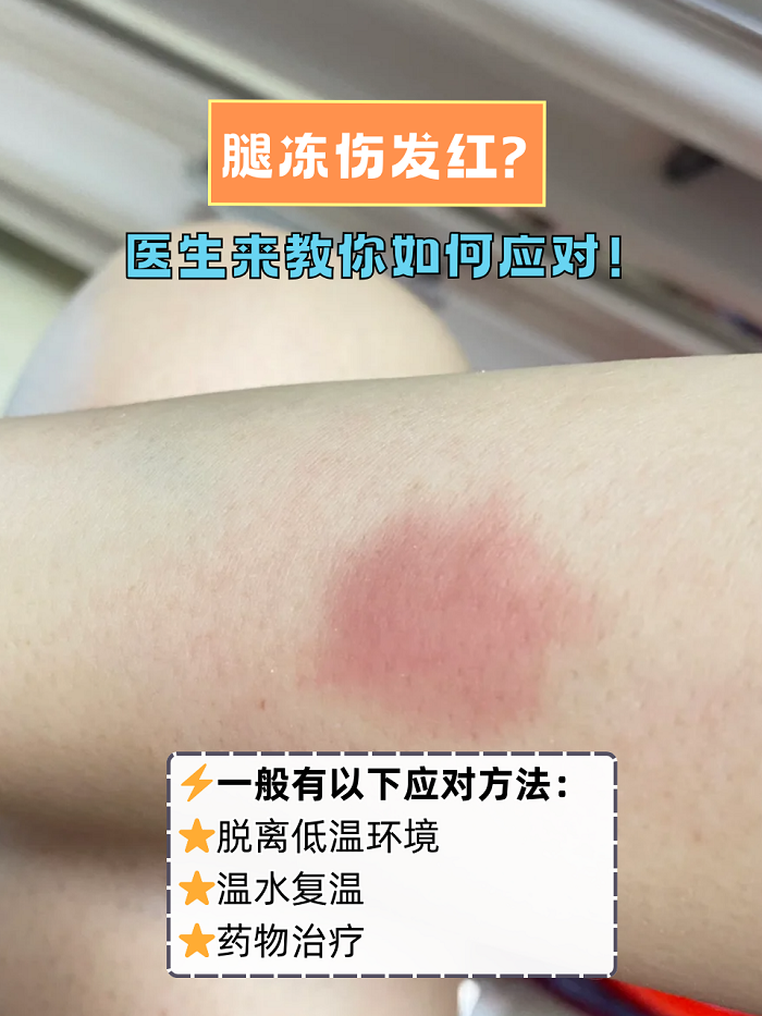 腿冻伤发红是怎么回事: 当长时间处于寒冷,潮湿的环境中,或者