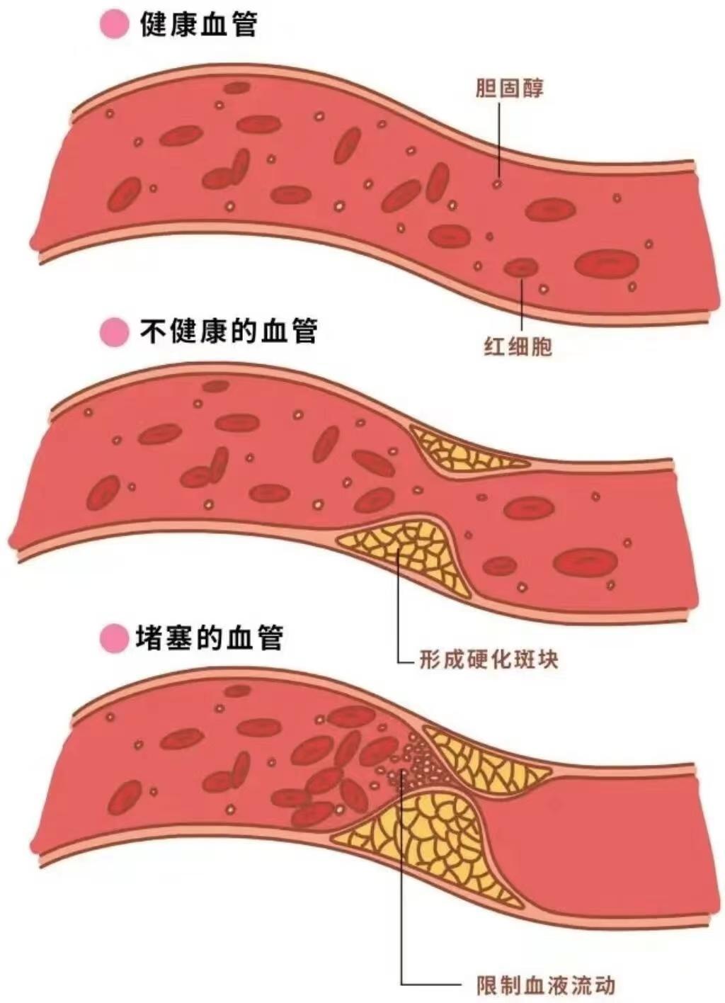 静脉曲张对健康有哪些影响# 大多数人认为,静脉曲张只是外表不好看