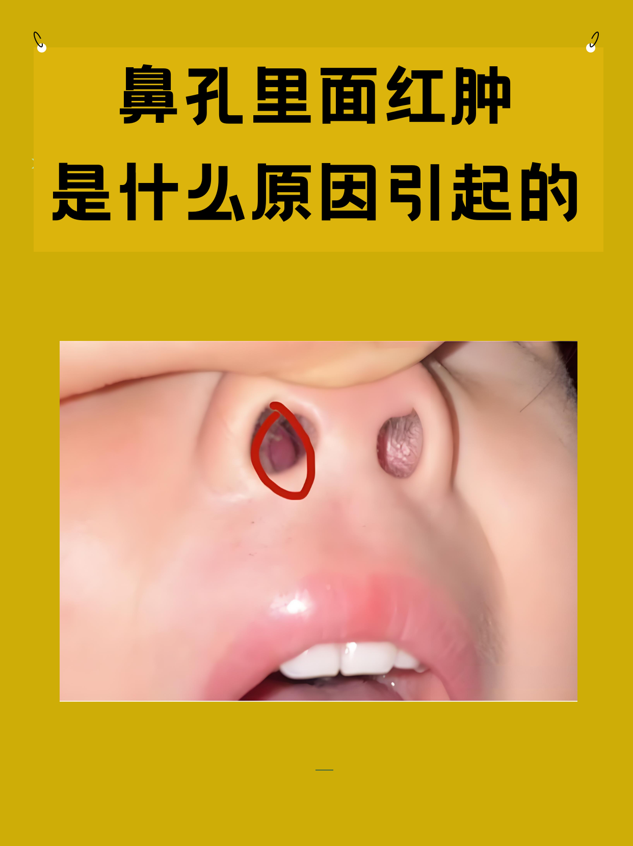鼻孔里面红肿是什么原因引起的