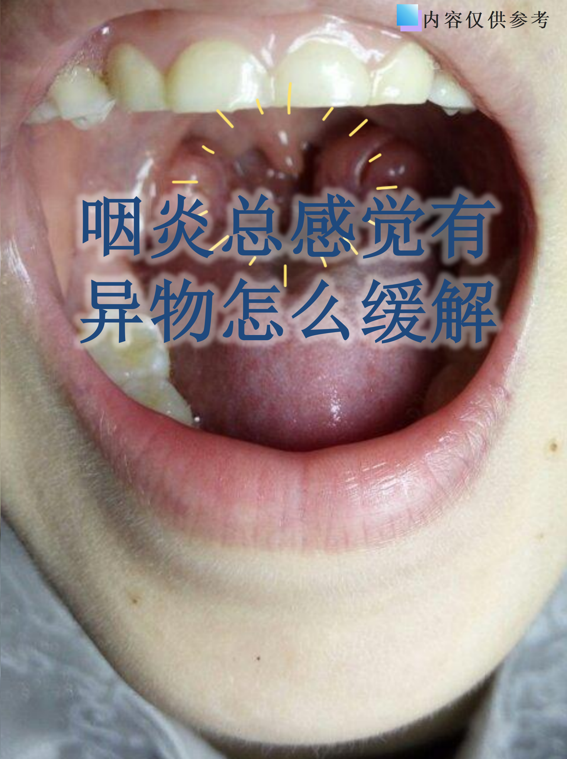 咽炎总感觉有异物怎么缓解