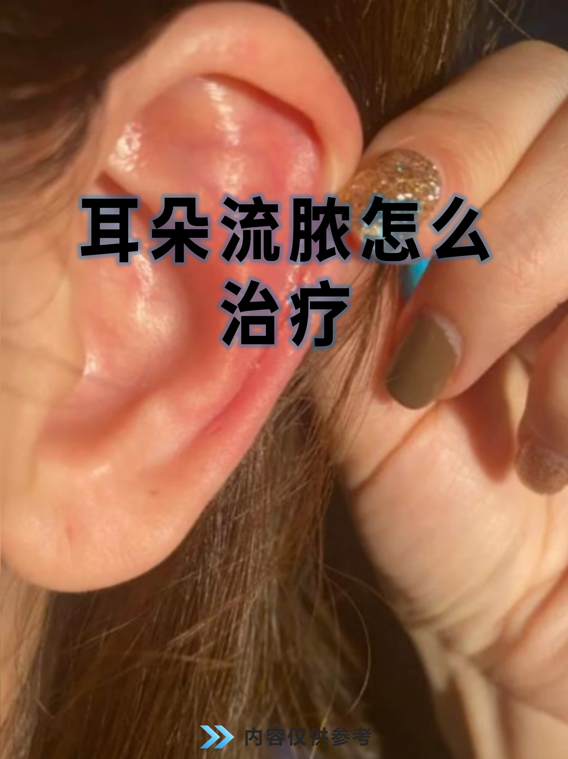 这种症状往往伴随疼痛或听力下降,及时处理能避免并发症