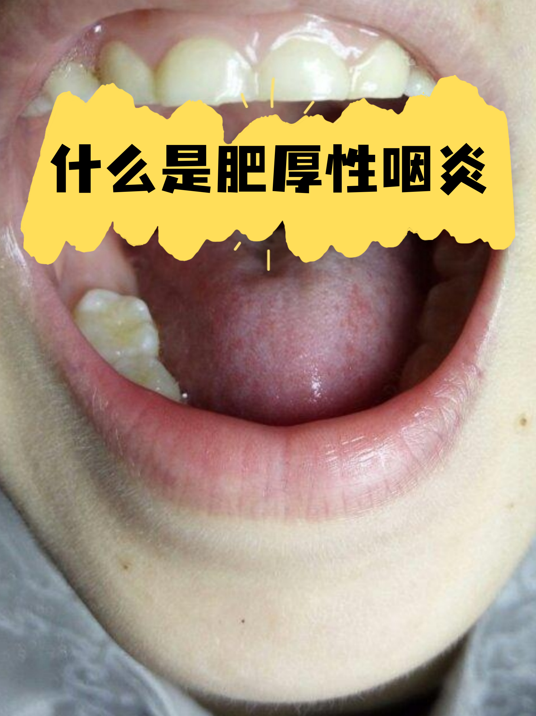 什么是肥厚性咽炎