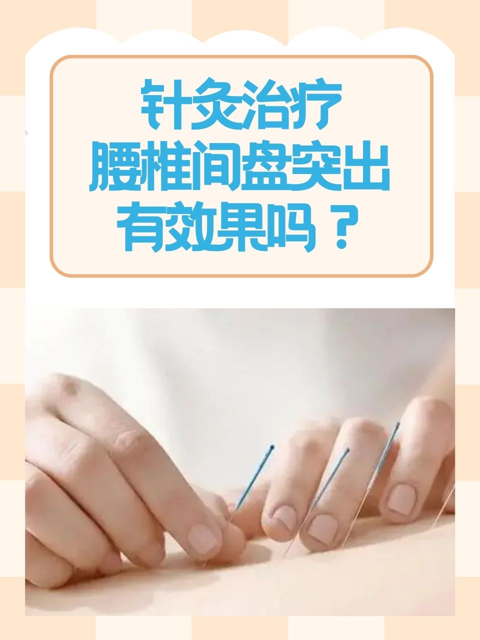 针灸治疗腰椎间盘突出有效果吗?