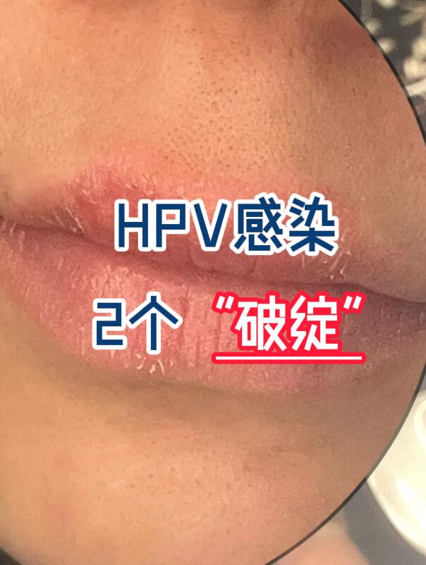 HPV感染