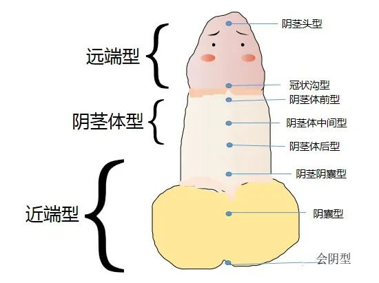 尿道下裂阴囊型图片